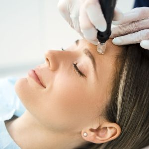 Microneedling treatment
